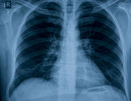 Nódulo no pulmão: imagem de um raio x do tórax.