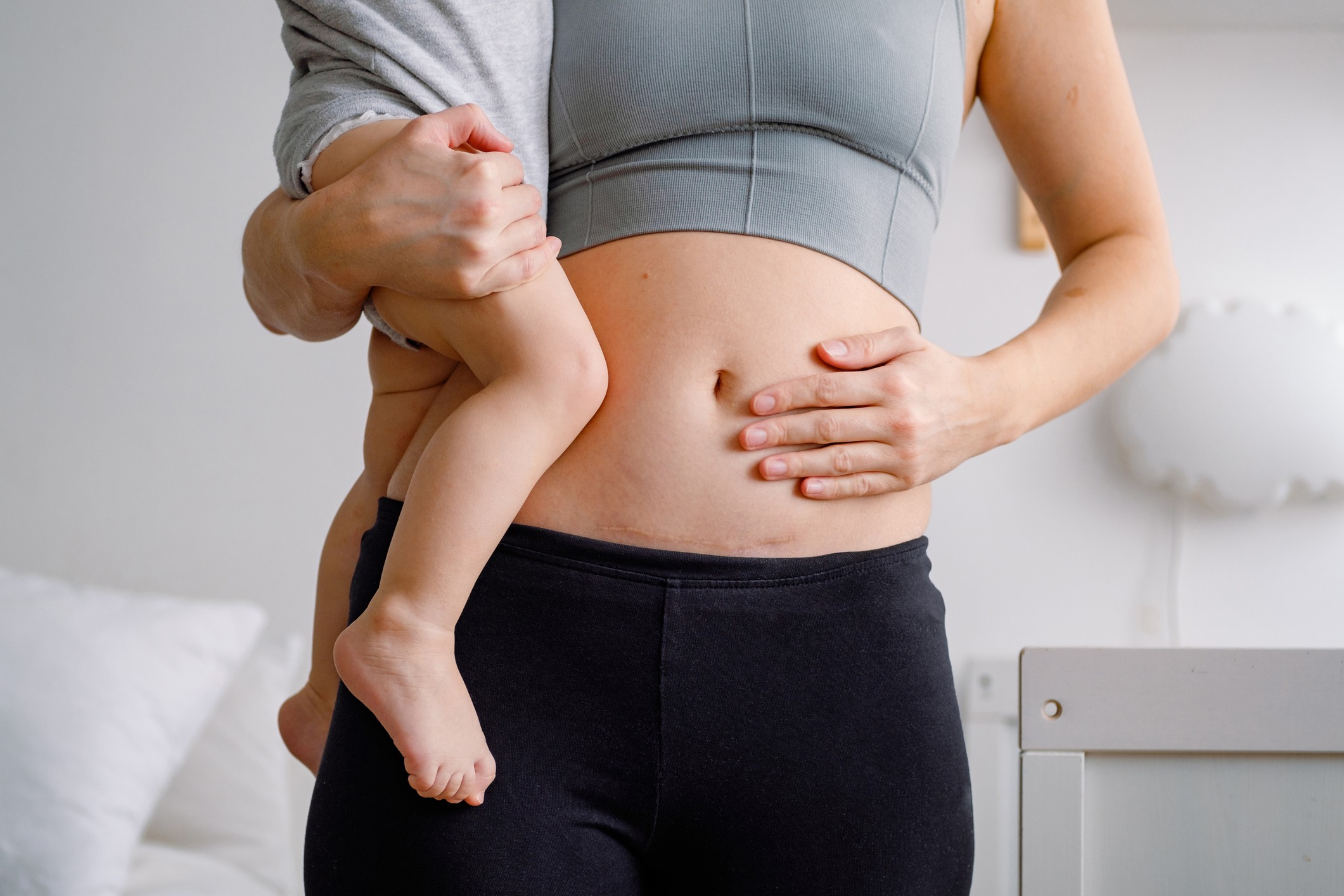 Como corrigir separação de músculos abdominais após a gravidez, que afeta  uma em três mães - BBC News Brasil