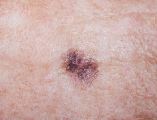 lesões cancer de pele