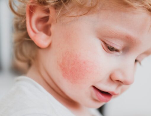 Dermatite atópica em crianças: quais são os sintomas e tratamentos