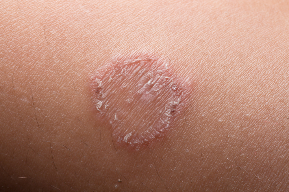 Micose: conheça 7 tipos de infecção causadas na pele