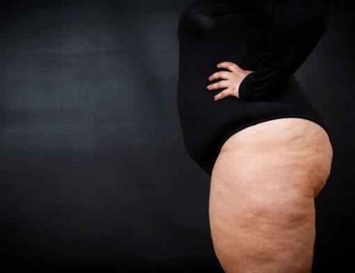 Lipedema: conheça a doença que provoca deformação corporal e é confundida com obesidade