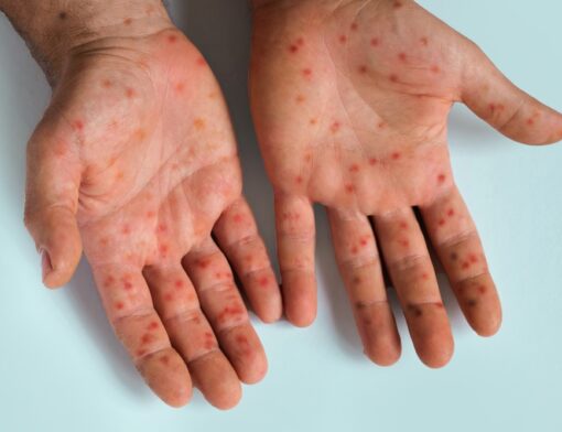 Mãos com pontos vermelhos arredondados, sinais de uma pessoa com sarampo.